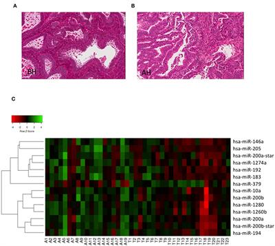 miRNAs as Candidate Biomarker for the Accurate Detection of Atypical Endometrial Hyperplasia/Endometrial Intraepithelial Neoplasia